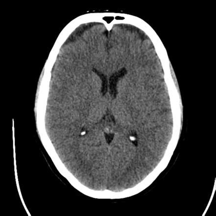 CT head (protocol) | Radiology Reference Article | Radiopaedia.org