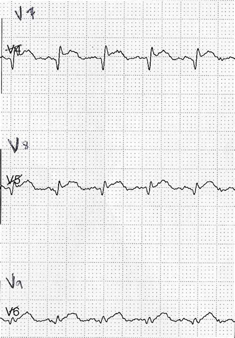 emDOCs.net – Emergency Medicine Educationposterior lead ECG - emDOCs ...