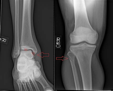 Tibia And Fibula Ankle Fracture