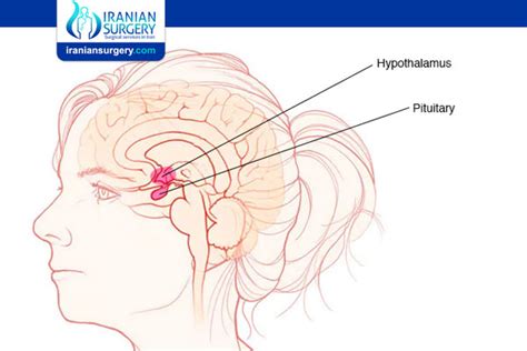 Prolactinoma | Iranian Surgery