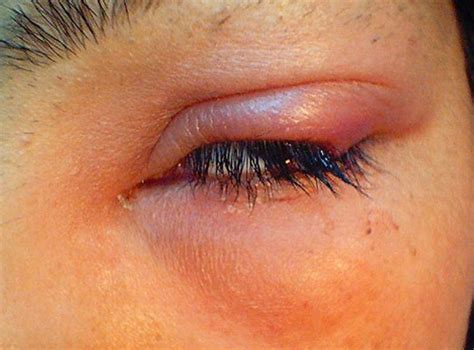 Swollen Eyelid | Medical Point