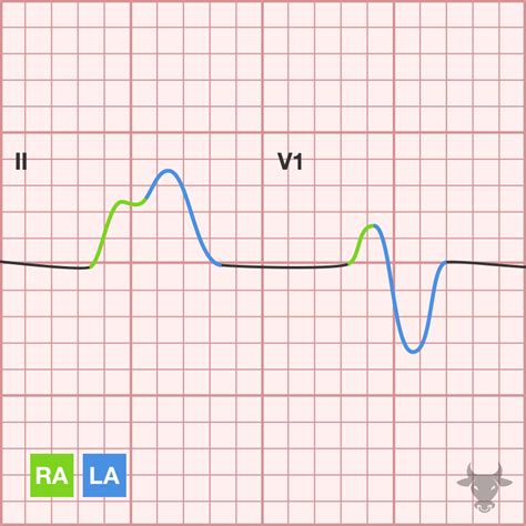 Atrial Enlargement On Ekg