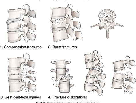 Do thoraco-lumbar spinal injuries classification systems exhibit lower ...