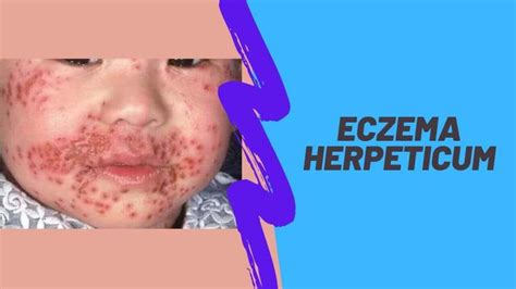 Eczema Herpeticum: Causes, Diagnosis, And Treatment