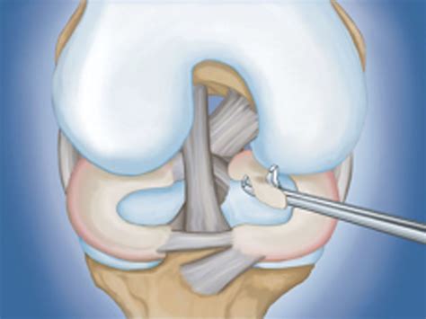 Meniscus tears and knee arthroscopic surgery - Welcome to Alosh Orthopedics