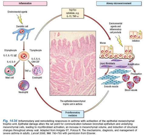 Pathophysiology of Bronchial Asthma - What happens in asthma - HubPages