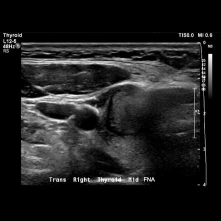 Assessment of thyroid lesions (ultrasound) | Radiology Reference ...