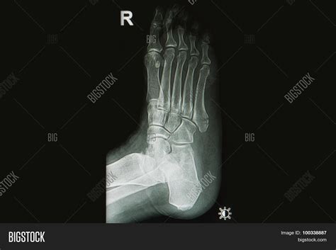 X-rays Image Injury Image & Photo (Free Trial) | Bigstock