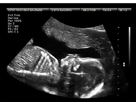 30 Weeks Ultrasound Boy