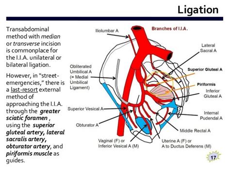 External Ligation of Internal Iliac Artery (E.L.I.I.A) - by Naira R.