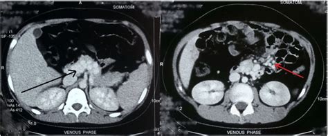 CECT abdomen (axial) showing multiple collaterals around the jejunum ...