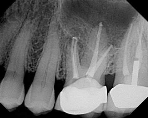 The Endo Blog: Persistent Post-Treatment (Apical) Periodontitis.