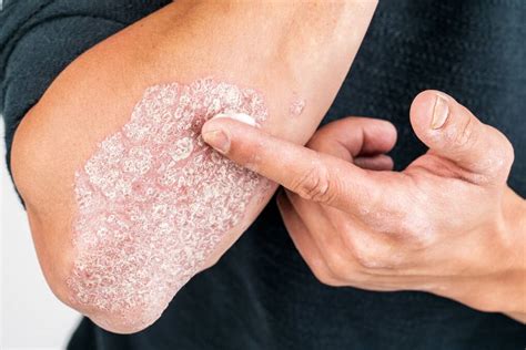 Your Health | Psoriasis is more than skin deep | The North West Star ...