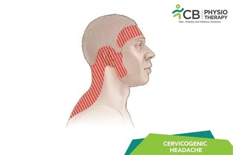 What Is Cervicogenic Headache?, Symptoms, Causes, Diagnosis ...