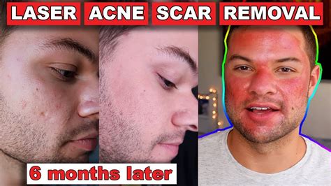 Acne Scars Before And After Laser