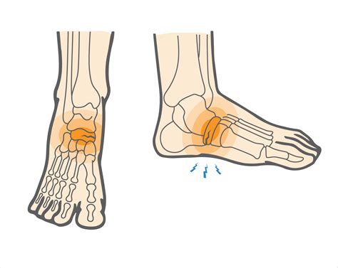 What is Navicular Stress Fracture & How to Heal Foot Injuries ...