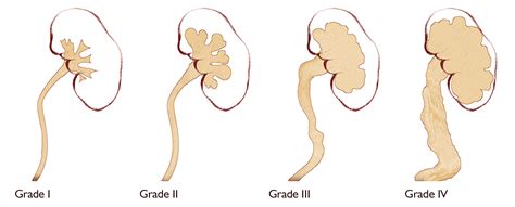 hydronephrosis