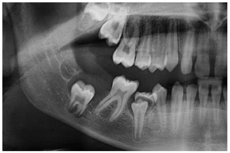 Eruption Cyst Radiography