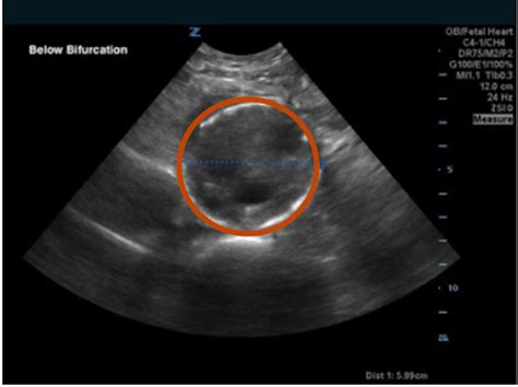 Bilateral Common Iliac Artery Aneurysm - JETem