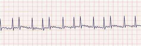 Atrial Fibrillation - ACLS Medical Training