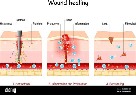 wound healing. Stages of the post-trauma repairing process. Hemostasis ...