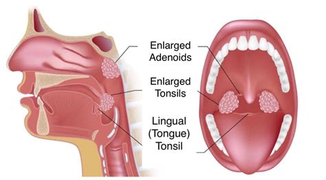 Surgery for Obstructive Sleep Apnea - Fort Worth ENT & Sinus