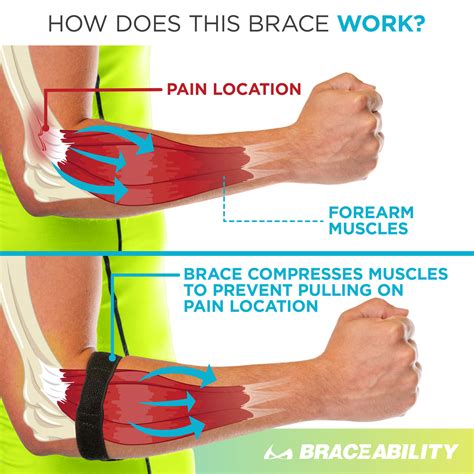 Epicondylitis Brace | Elbow Strap for Medial & Lateral Epicondyle Pain