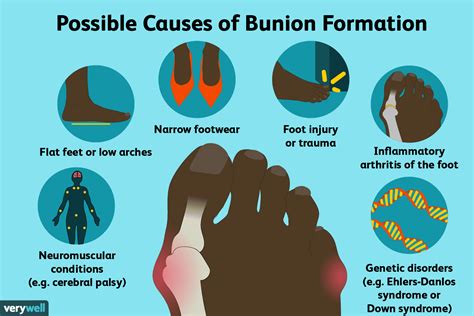 Understanding Bunions and How to Soothe Your Pain (2022)