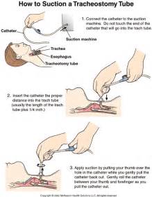 Tracheostomy Tube Suctioning