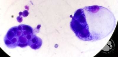 Lung cancer metastasis to pleural fluid