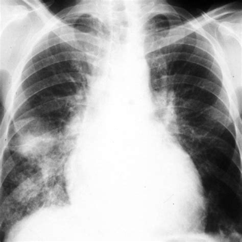 Diffuse Alveolar Hemorrhage Syndrome