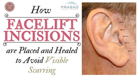 How Visible Facelift Incision Scars are Avoided, Treated, and Healed ...