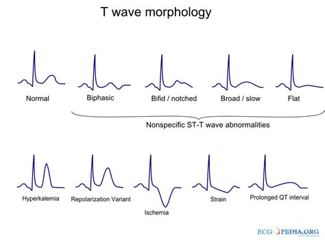 File:T wave morphology.png - ECGpedia