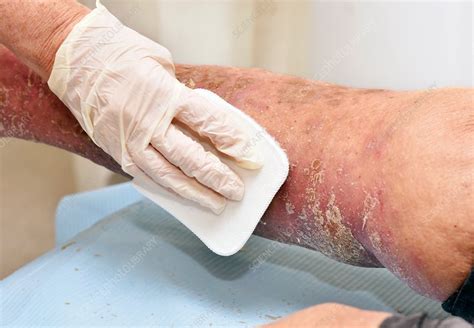 Debridement of skin lesions - Stock Image - C037/0900 - Science Photo ...