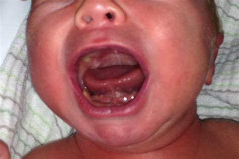 Tongue Tie (Ankyloglossia) - Infant & Newborn - Causes, Treatment