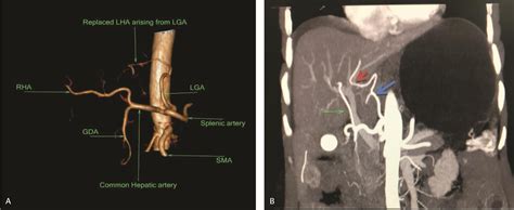 Assessment of Celiac Axis and Hepatic Artery Variations in ...