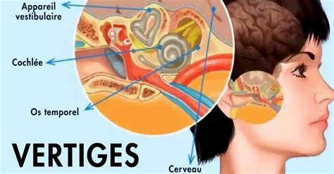 Labyrinthitis. Symptoms, causes and treatments - Archynewsy