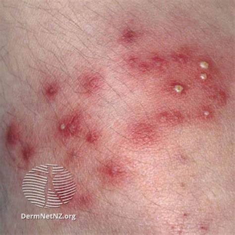 Superficial bacterial folliculitis treatment | Dermatology Games