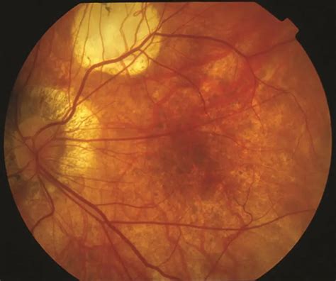 Myopic macular degeneration - American Academy of Ophthalmology