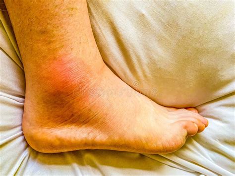 Red Swollen Ankle on Foot Due To Acute Gout Stock Photo - Image of ...