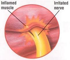 Muscle Spasm Massage