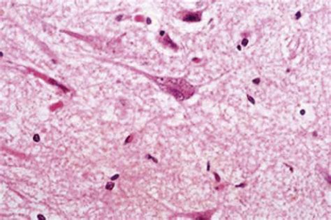 Neurofibrillary Tangles