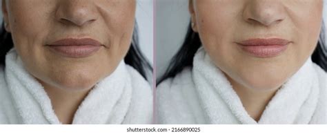 Woman Double Chin Before After Treatment Stock Photo 2166890025 ...