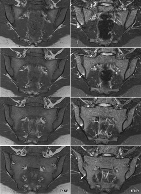 bone marrow edema sacroiliac joint treatment - stanovich-spillers