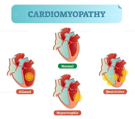 Cardiomyopathy medical disorders cross section diagram, vector ...