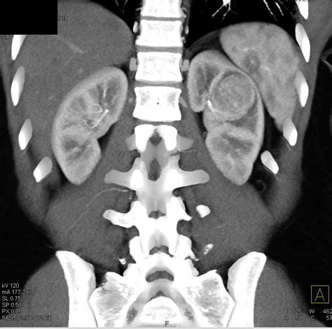 Oncocytoma Left Kidney - Kidney Case Studies - CTisus CT Scanning