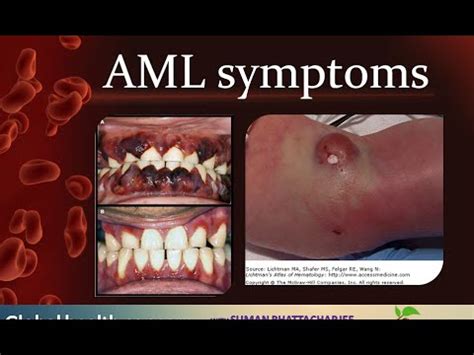 Acute myelogenous leukemia