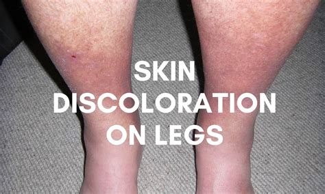 Skin Discoloration On Legs: Causes, Types & Treatments