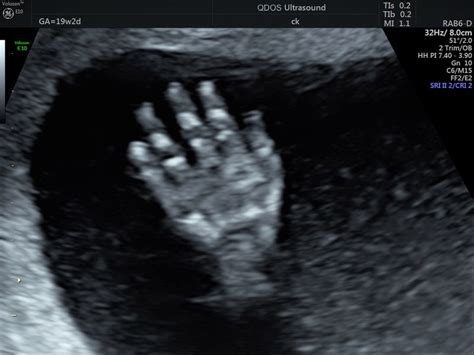 19 Week Scan Perth | Mid-trimester Ultrasound | Pregnancy Scan | Perth