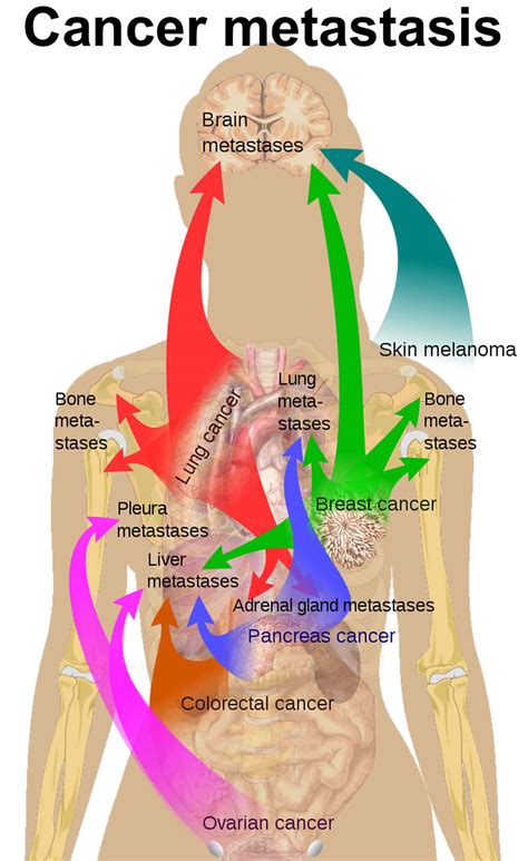 Lung Cancer Metastasis Symptoms